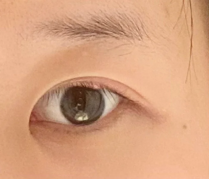 肖战麦粒肿