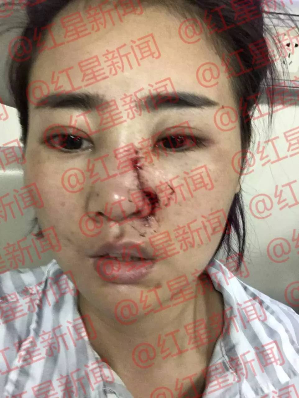 云南丽江女孩毁容事件