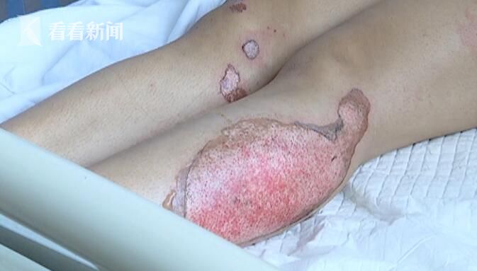 丽江少女毁容