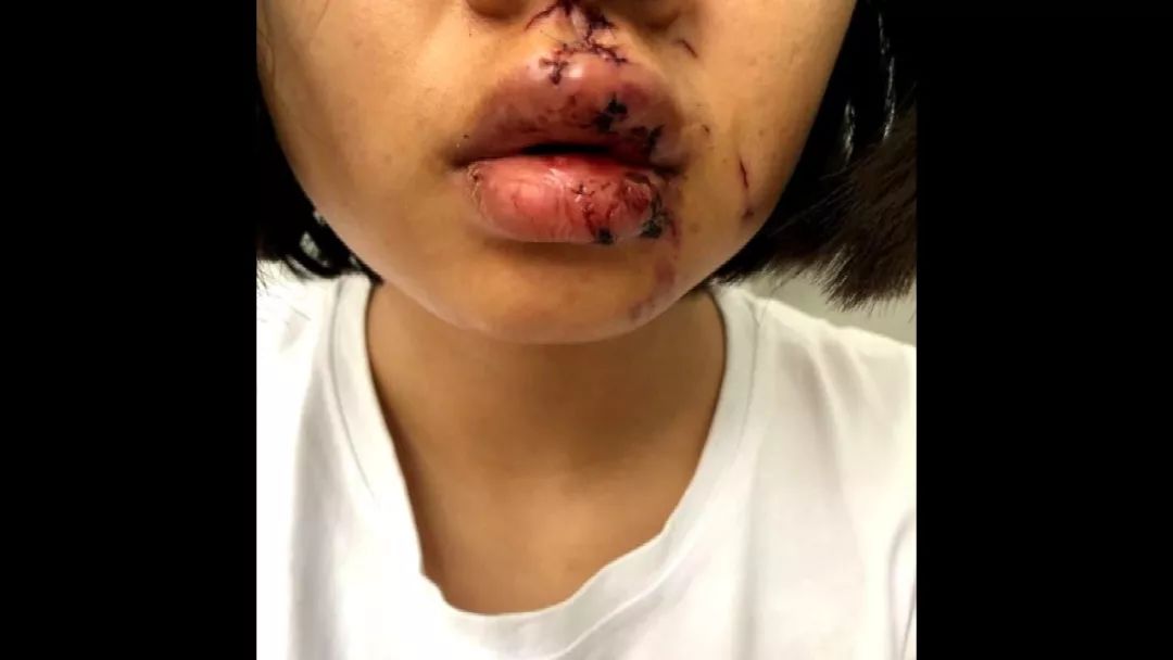 云南女孩毁容事件真相