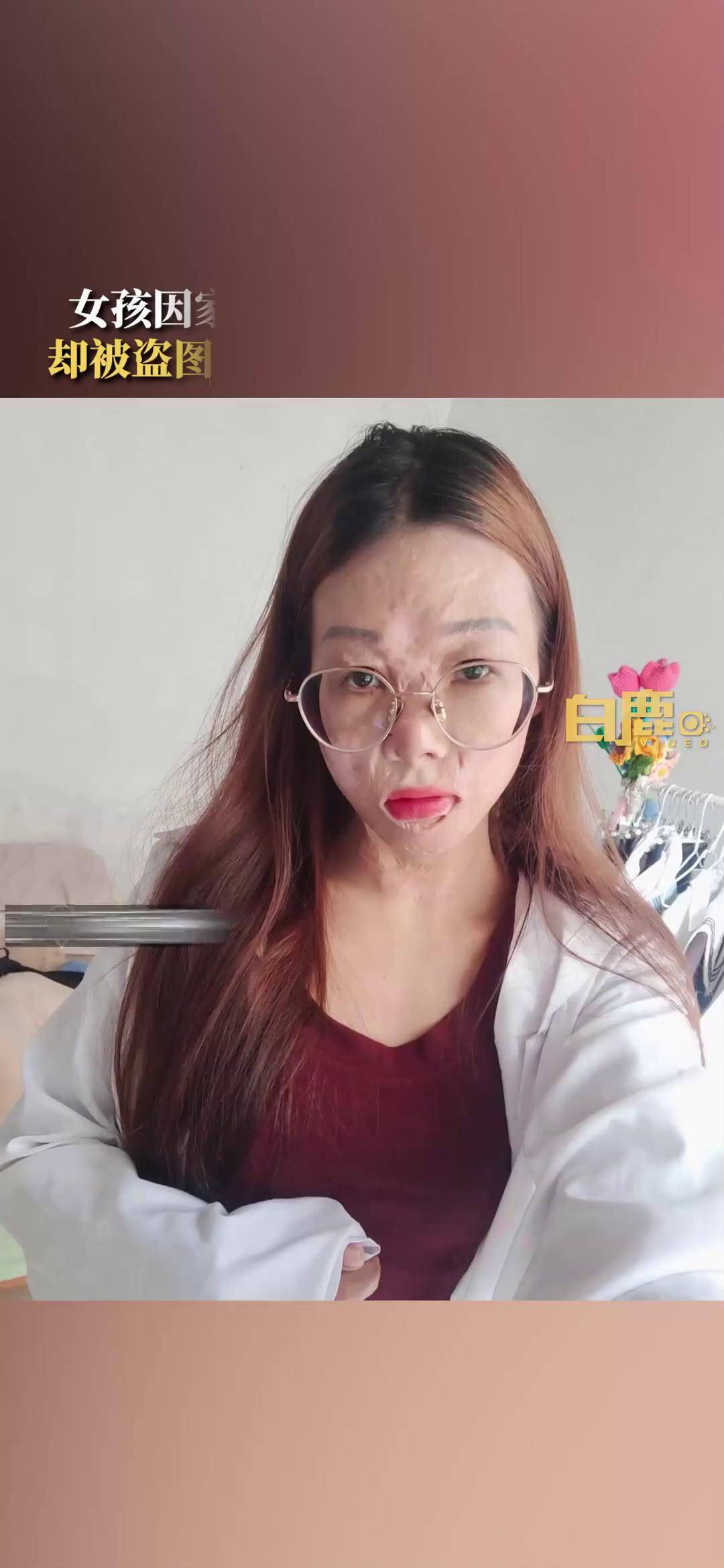 云南被毁容女孩