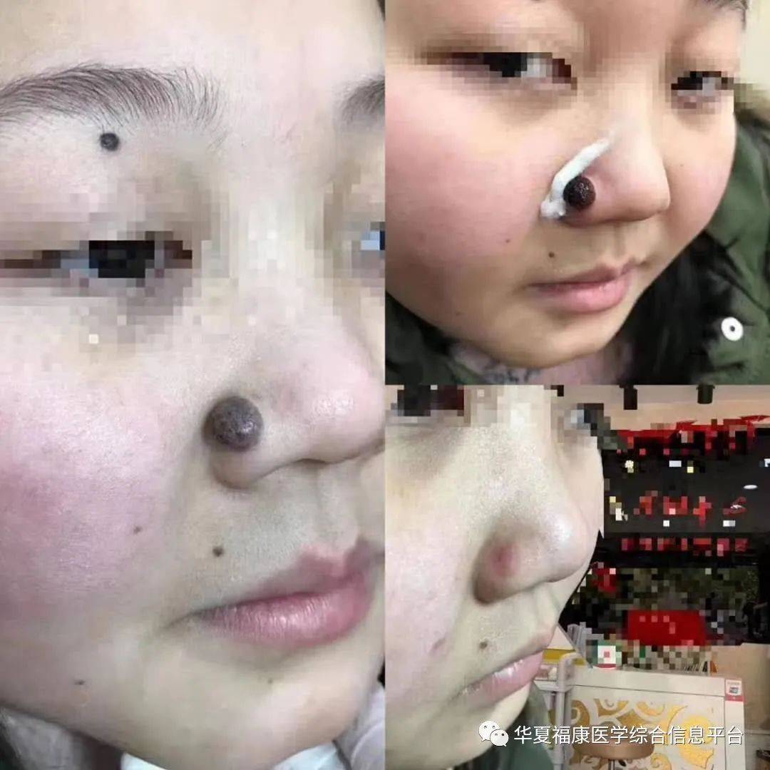 去红血丝的偏方