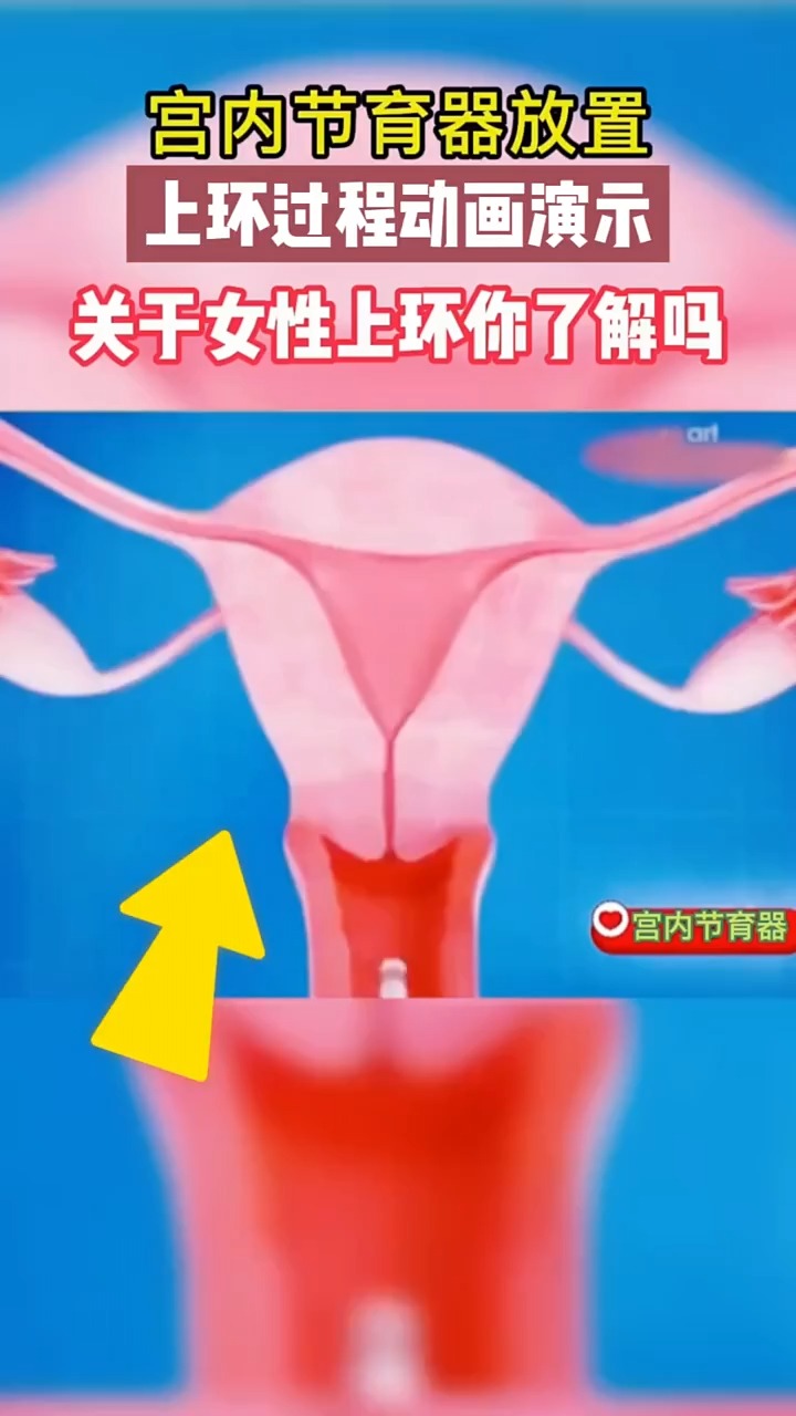 节育环的道理