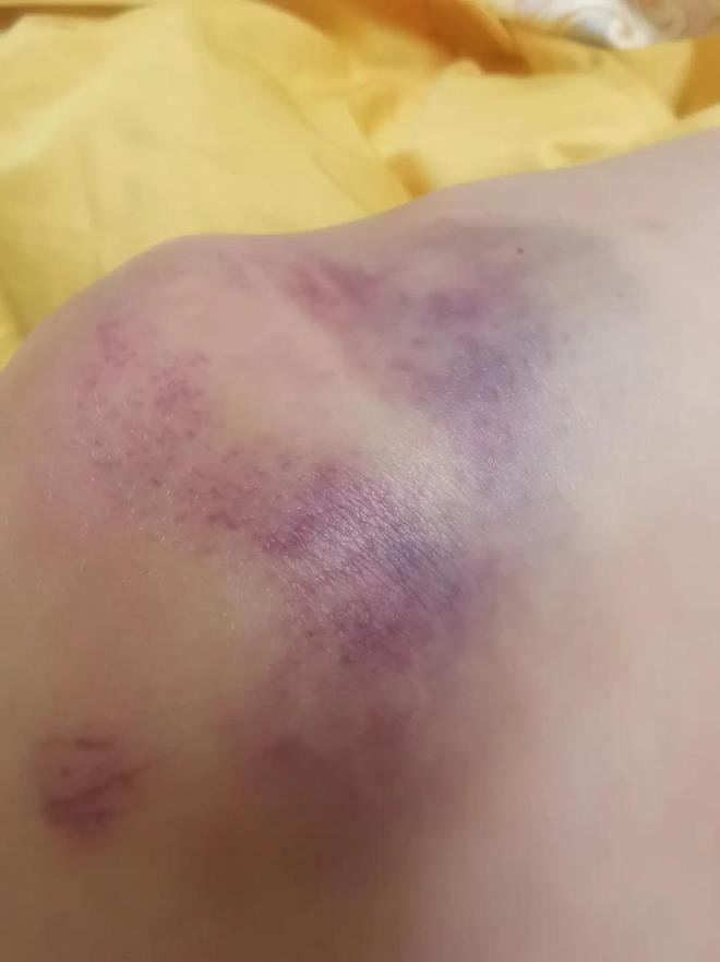 云南被打毁容女子现状