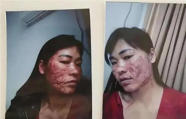 云南被打毁容女子近况